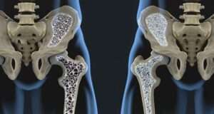 Қарттардағы остеопороз ауруы