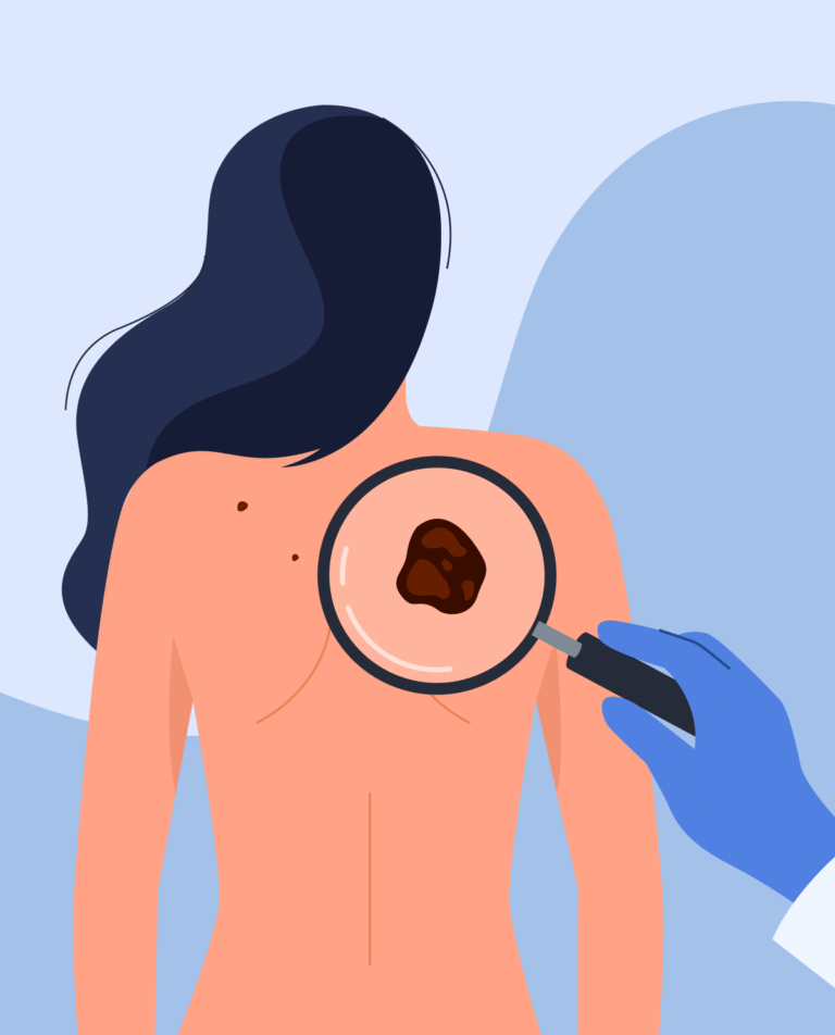 Рак кожи: что нужно знать каждому