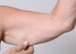 Саркопения: что это и как её предотвратить