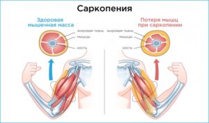 Что такое Саркопения?