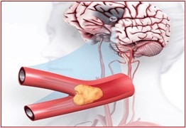 «Всемирный день борьбы с инсультом: защити себя и близких!»