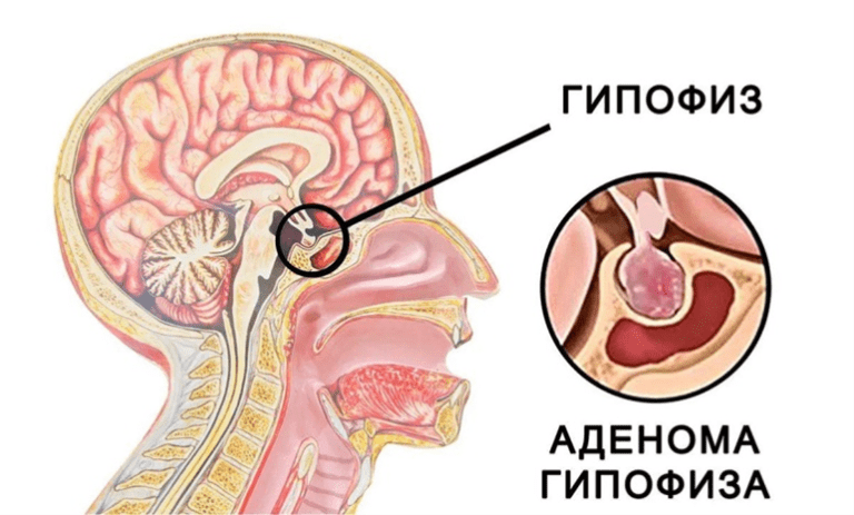 Аденома гипофиза: когда стоит насторожиться и как сохранить здоровье