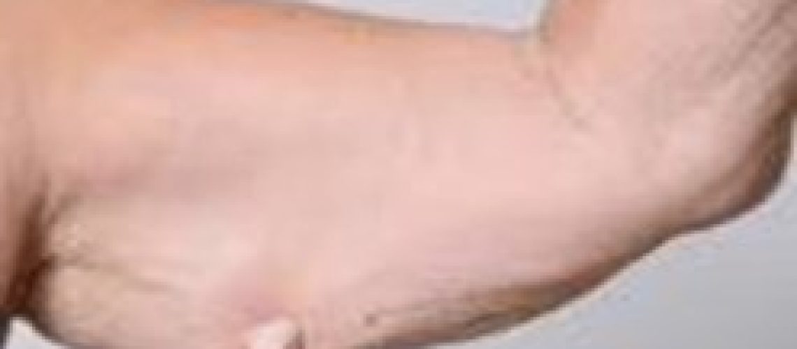 Саркопения ЗОЖ 1