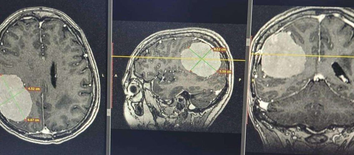 Нейрохирурги Национального госпиталя случайно обнаружили у пациентки гигантскую опухоль мозга