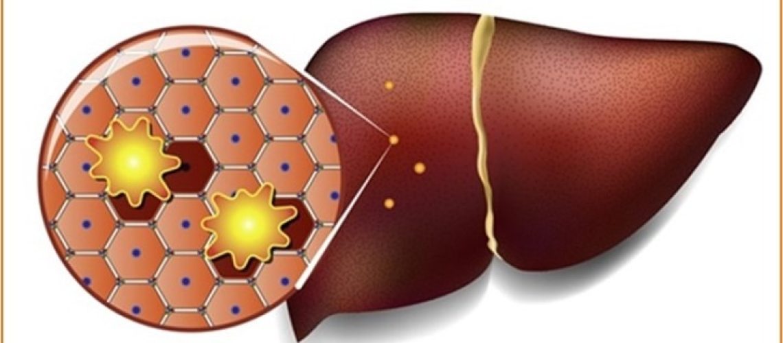 Жировая болезнь печени 1