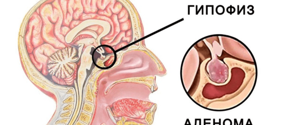 Аденома гипофиза 1