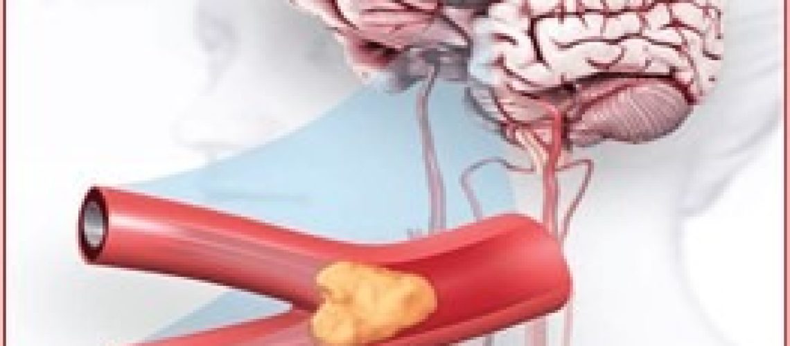 Всемирный день борьбы с инсультом