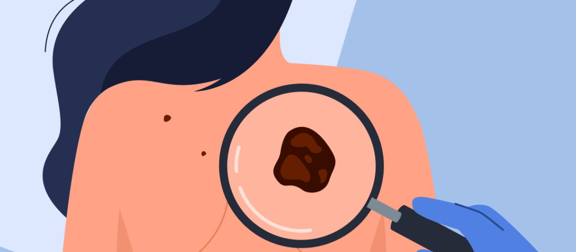 Рак кожи рус