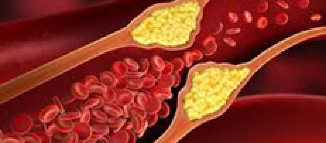 Что такое дислипидемия