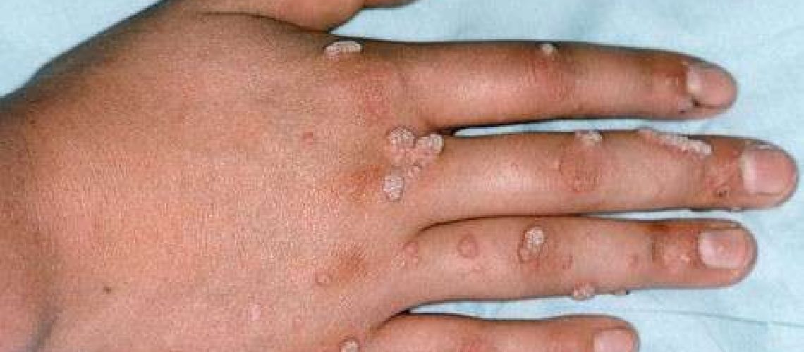 Вирус папилломы 1