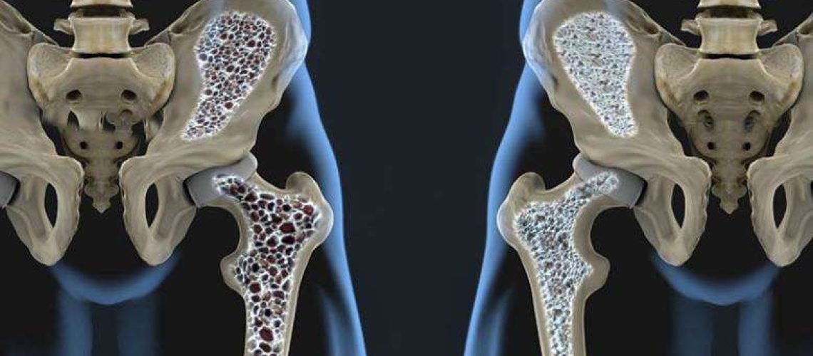 Остеопороз у пожилых 1