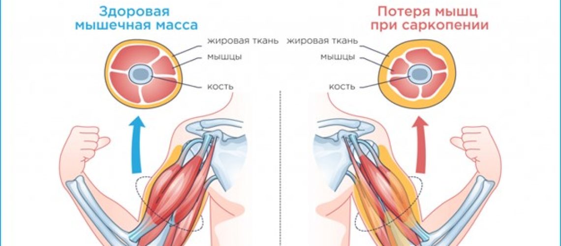 Саркопения ЗОЖ 2